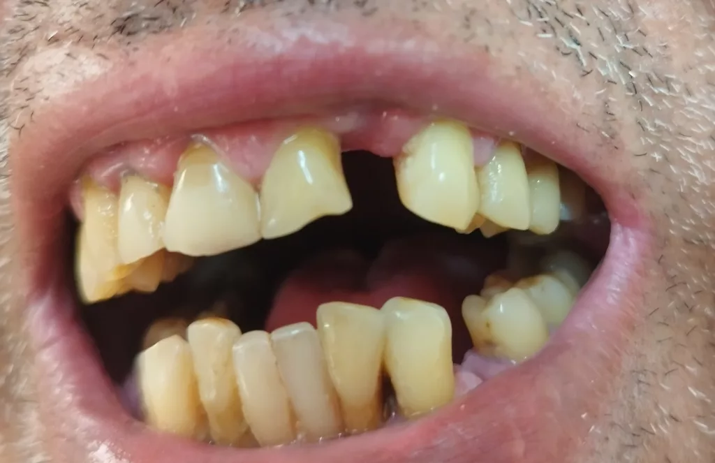fabricación de protesis semiflexible para clinicas dentales en barcelona